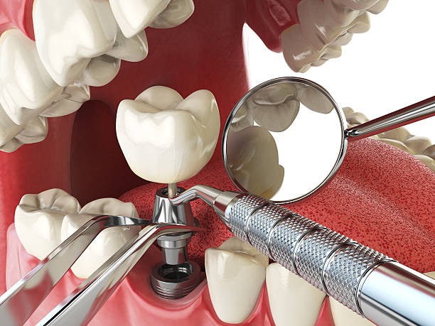 Best Emergency Root Canal Therapy in Fredonia, WI